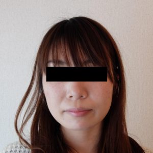 小顔矯正モニター89前
